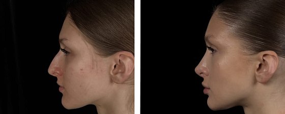 Ринопластика: до и после – фото 4